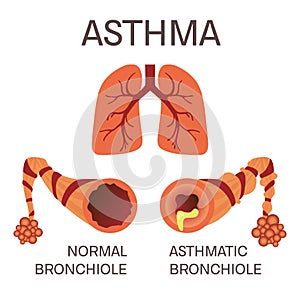 Normal and asthmatic bronchioles