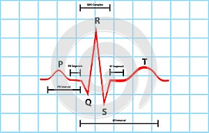 Normal Atrial And Ventricular Depolarization With