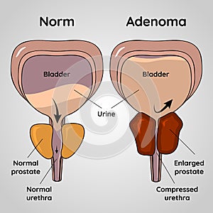 Normal bladder and BPH problem, prostate adenoma medical vector illustration