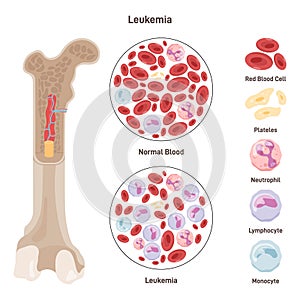 Normal blood and blood affected by leukemia disease. Dangerous