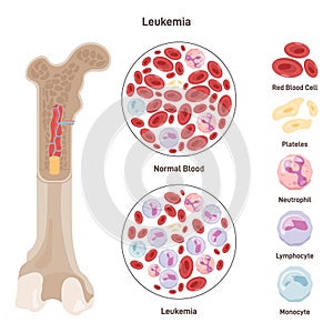Normal blood and blood affected by leukemia disease. Dangerous photo