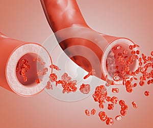 normal blood vessel and widening blood vessels, Vasodilation photo