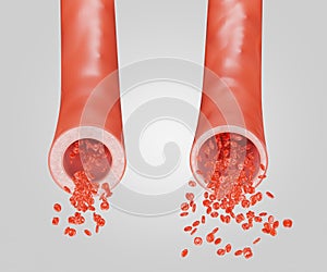 normal blood vessel and widening blood vessels, Vasodilation photo