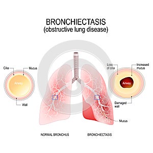 Normal bronchus and bronchiectasis. obstructive lung disease photo