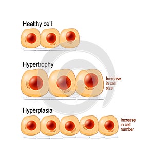 Normal cells, hypertrophy, and hyperplasia photo