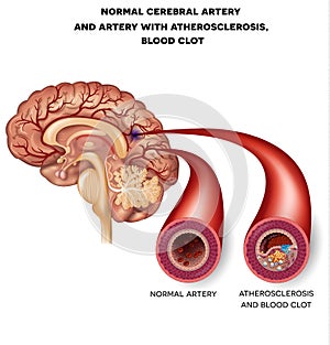 Normal cerebral artery and artery with blood clot