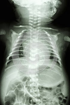 Normal chest of infant