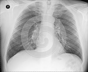 Normal chest X ray