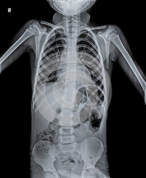 Normal Chest X Ray of human child.