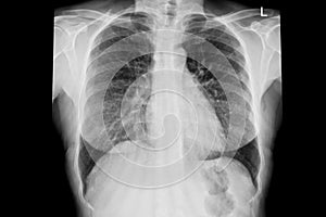 Normal chest x-ray image demonstrated heart,lungs,ribs,bones and muscles