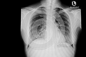 Normal chest x-ray image demonstrated heart,lungs,ribs,bones and muscles