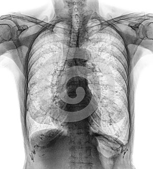 Normal chest X-ray of old patient . You can seen calcification at rib , trachea , bronchus . Front view