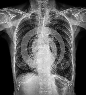 Normal chest X-ray of old patient . You can seen calcification at rib , trachea , bronchus . Front view