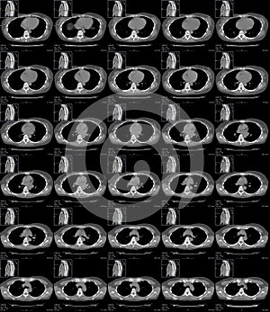 Normal chest on series of CT images