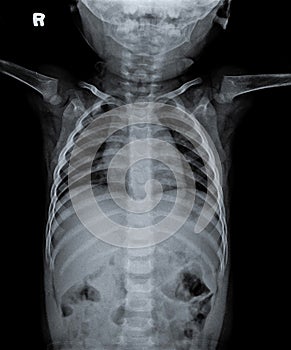 Normal Chest X Ray of human child.