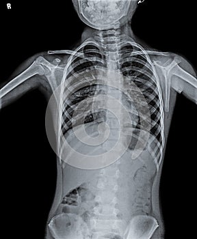Normal Chest X Ray of human child.