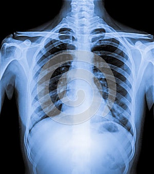 Normal Chest X Ray of human