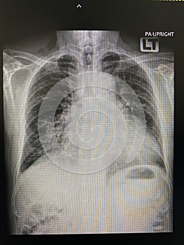 Normal chest x-ray Medical Technology and Science concept.