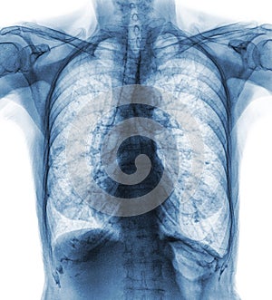 Normal chest X-ray of old patient . You can seen calcification at rib , trachea , bronchus . Front view photo