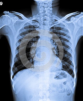Normal Chest X Ray