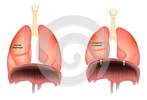Normal diaphragm or Diaphragmatic eventration. Abnormal elevation of a portion or entire hemidiaphragm.