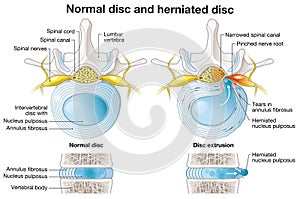 Normal disc and herniated disc, slipped disc, labelde illustration