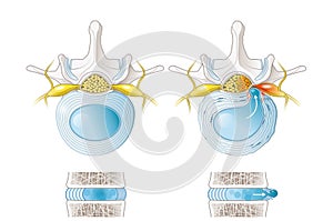 Normal disc and herniated disc, slipped disc, labelde illustration