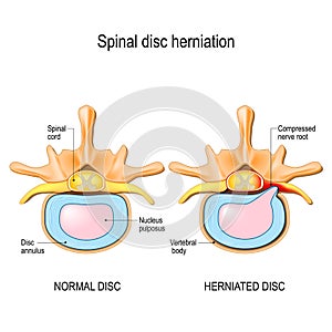 Normal disc and spinal disc herniation in cervical vertebrae