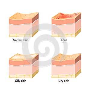 Normal, dry and oily skin. Acne. Skin disorder photo