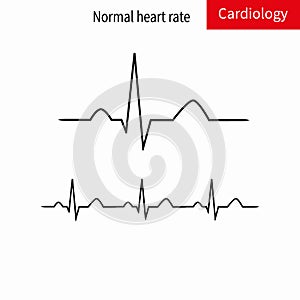 Normal ECG complex and normal sinus rhythm. photo