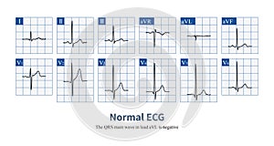 Normal ECG