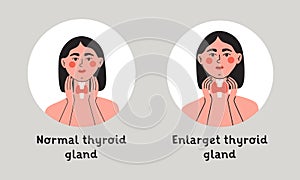 Normal and enlarget thyroid gland. Woman showing thyroid gland on her neck. Endocrinology system symbol, organ