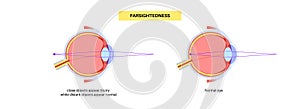Normal eye and farsightedness