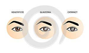 Normal eye, glaucoma and cataract, medical vector illustration