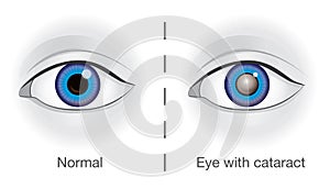 Normal eye and lens clouded by cataract.