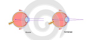 Normal eye and nearsightedness
