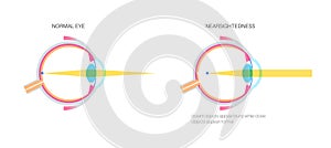 Normal eye and nearsightedness