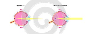 Normal eye and nearsightedness