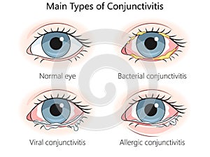 Main Types Conjunctivitis diagram medical science photo