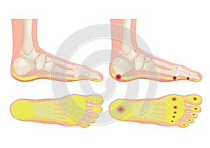 Normal foot and a foot with a fat pad atrophy / callus