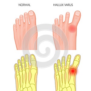 Normal foot and Hallux varus photo