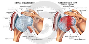 Normal and frozen shoulder joints