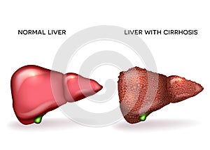 Normal healthy liver and Liver with Cirrhosis