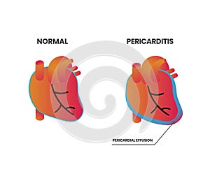 Normal heart anatomy vs pericarditis vector illustration photo