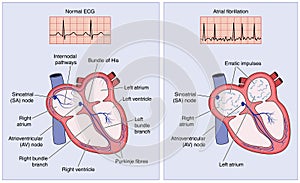 Normal heart electrical conduction and atrial fibrillation photo