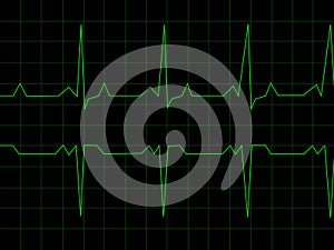 Normal Heart Rhythm