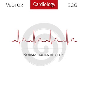 Normal heart rhythm( normal sinus rhythm).