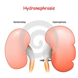 Normal human`s kidney and kidney affected by Hydronephrosis photo