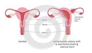 Normal human uterus and unicornuate uterus with non-comunicating uterine horn. Congenital uterine malformation anatomy