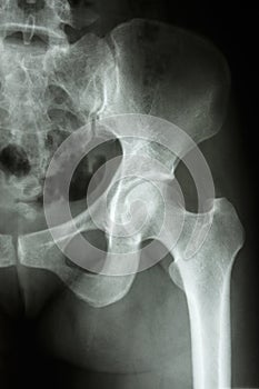 Normal humans hip